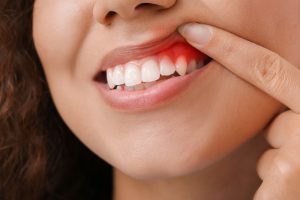 Understanding and Preventing Gum Disease in Kids: A Comprehensive Guide